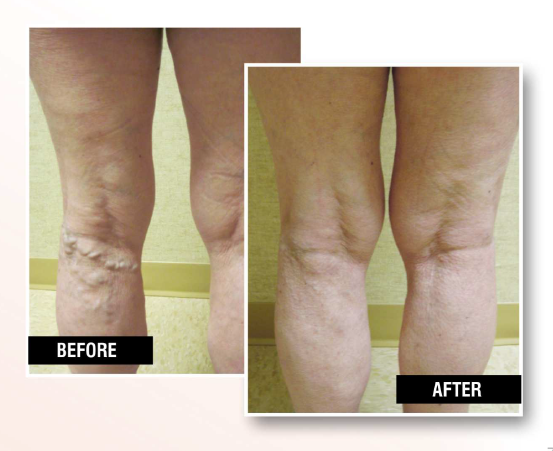 Varicose Veins|<image-caption/>|USA Vein Clinics” title=”Varicose Veins|<image-caption/>|USA Vein Clinics” /></div>
<p><!-- END scald=3139 --></div>
</div>
</p><div id=