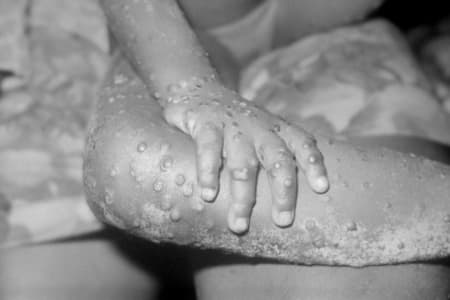 bumps associated with monkeypox